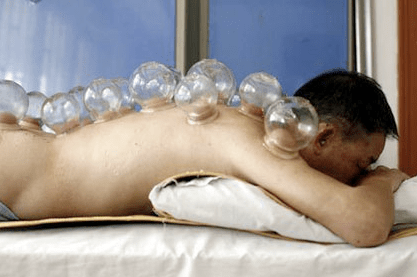 cupping